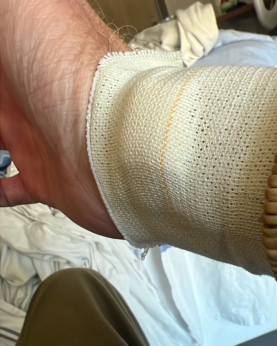 The author&rsquo;s bandaged wrist, resting on a hospital bed in Oakville, Ontario